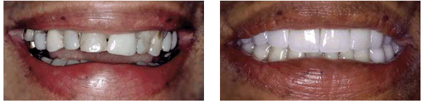 Porcelain Bonded Restorations