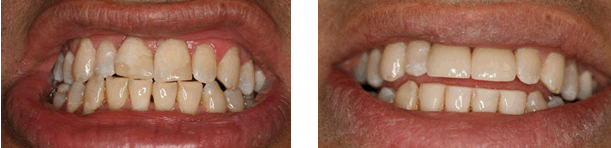 Porcelain Veneers & Bonding