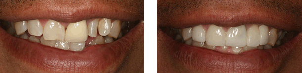 Porcelain Veneers and Porcelain Crowns