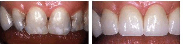 Porcelain Crowns