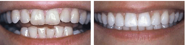 Invisalign and Bonding