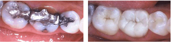 Posterior Composite Restorations and Porcelain Crowns